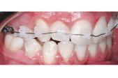 Brackets Aqua Roth .022 Kit 3-3 Sup.
