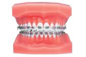 Brackets Elite Roth .022 1 Caso Sup.e Inf.Con Gancho